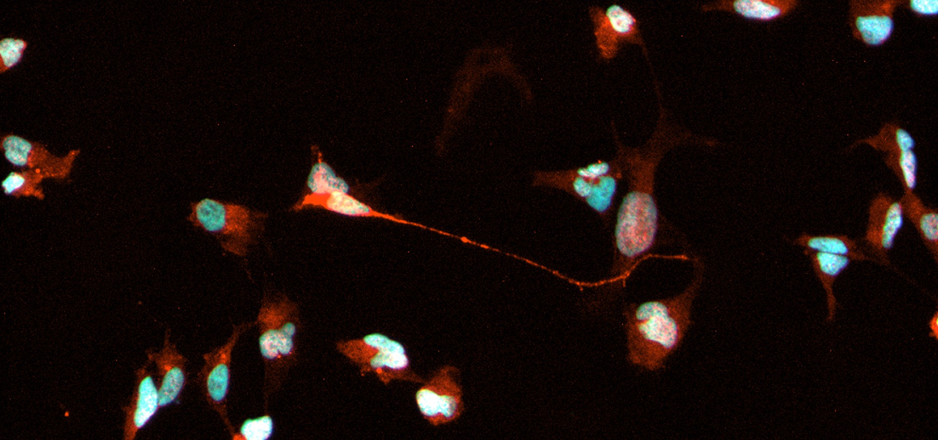 Parkinsonismos atípicos