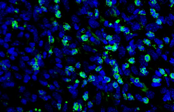 En verde la tinción de los linfocitos antitumorales tipo NK y en azul, las células tumorales.  ➡️ El tratamiento con #ranolazina aumenta la cantidad de linfocitos antitumorales que infiltran el tumor y favorecen la acción de la inmunoterapia. 